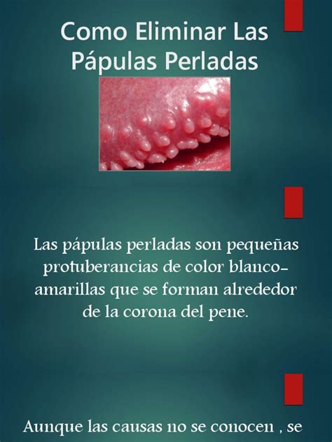 papulas perleadas|Pápulas perladas